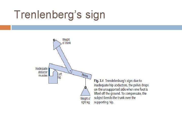 Trenlenberg’s sign Trenlenberg’s sign
