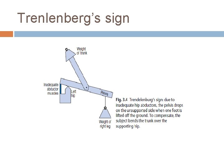 Trenlenberg’s sign 