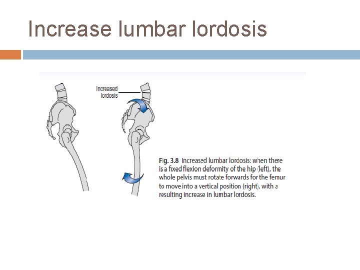 Increase lumbar lordosis 
