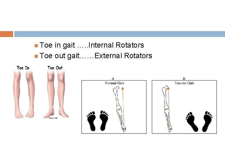  Toe in gait …. . Internal Rotators Toe out gait……External Rotators 