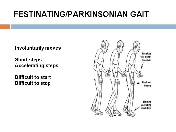 FESTINATING/PARKINSONIAN GAIT Involuntarily moves Short steps Accelerating steps Difficult to start Difficult to stop FESTINATING/PARKINSONIAN GAIT Involuntarily moves Short steps Accelerating steps Difficult to start Difficult to stop