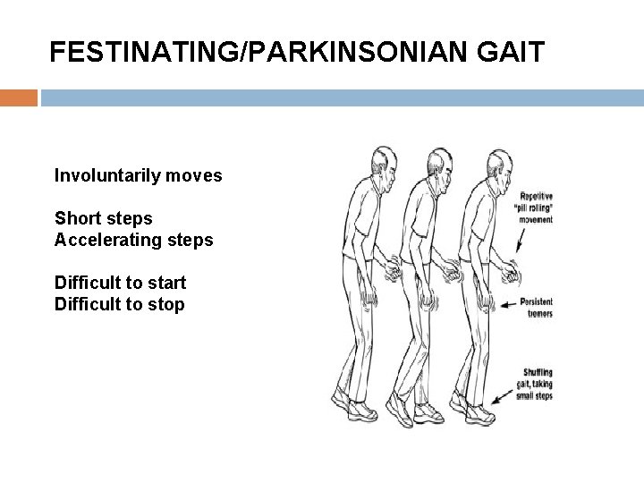 FESTINATING/PARKINSONIAN GAIT Involuntarily moves Short steps Accelerating steps Difficult to start Difficult to stop