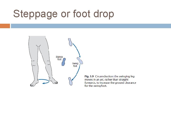 Steppage or foot drop 