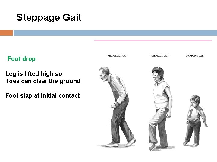 Steppage Gait Foot drop Leg is lifted high so Toes can clear the ground