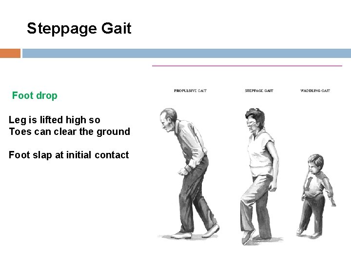 Steppage Gait Foot drop Leg is lifted high so Toes can clear the ground Steppage Gait Foot drop Leg is lifted high so Toes can clear the ground