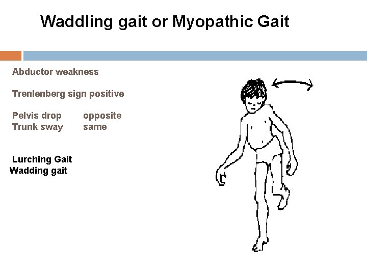 Waddling gait or Myopathic Gait Abductor weakness Trenlenberg sign positive Pelvis drop Trunk sway
