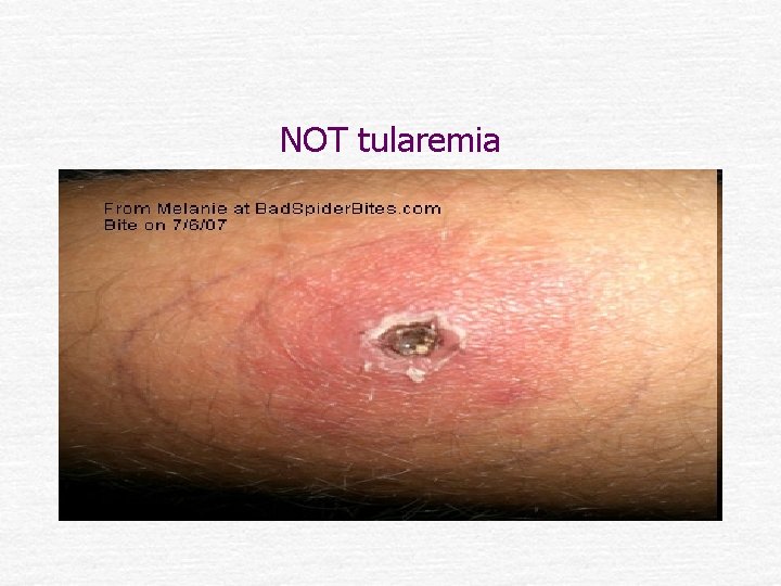 NOT tularemia 