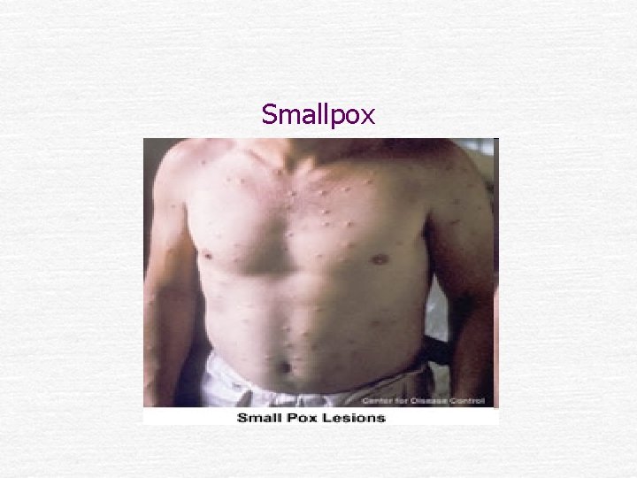 Smallpox 