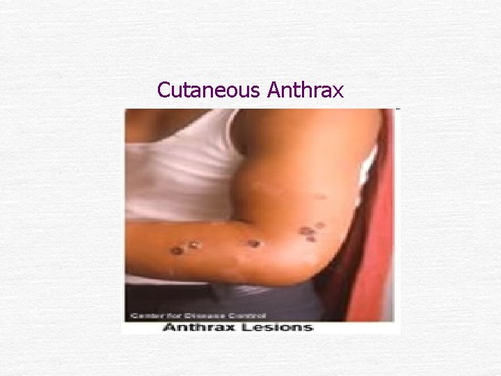 Cutaneous Anthrax 