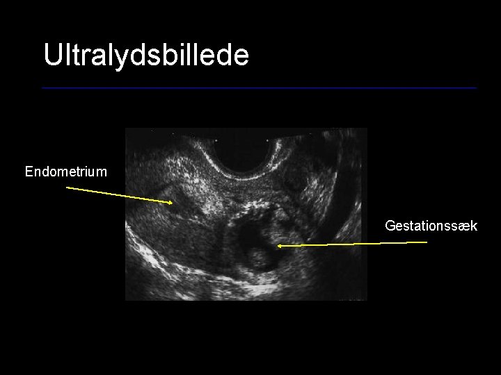 Ultralydsbillede Endometrium Gestationssæk 