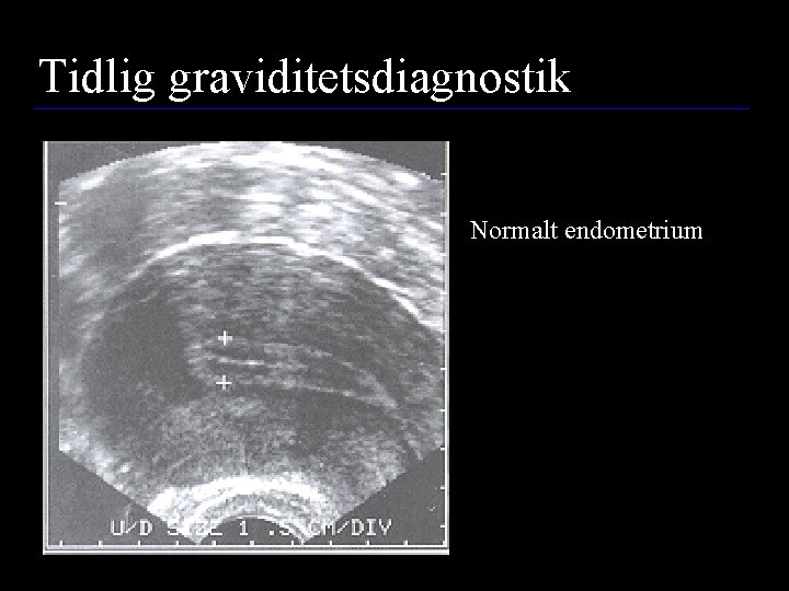 Tidlig graviditetsdiagnostik Normalt endometrium 