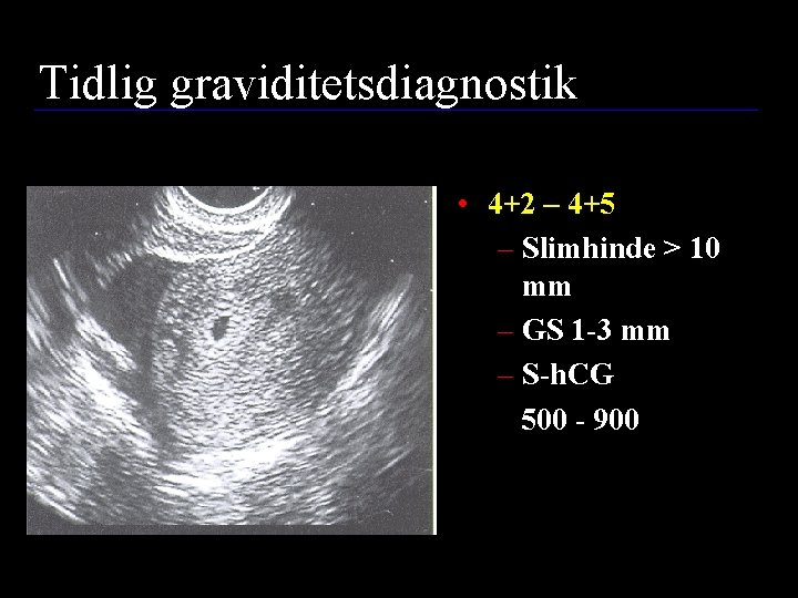 Tidlig graviditetsdiagnostik • 4+2 – 4+5 – Slimhinde > 10 mm – GS 1