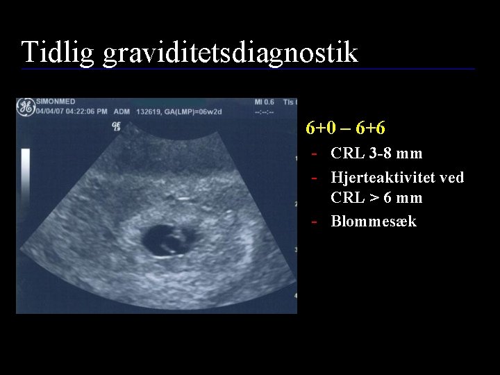 Tidlig graviditetsdiagnostik • 6+0 – 6+6 - CRL 3 -8 mm - Hjerteaktivitet ved