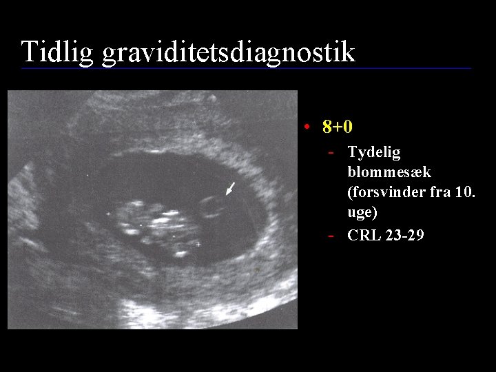 Tidlig graviditetsdiagnostik • 8+0 - Tydelig blommesæk (forsvinder fra 10. uge) - CRL 23