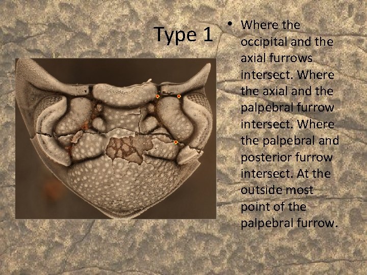 Type 1 • Where the occipital and the axial furrows intersect. Where the axial