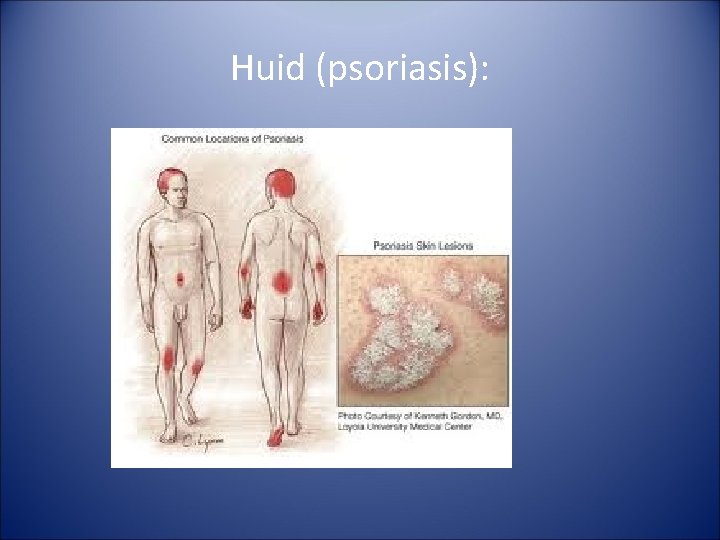 Huid (psoriasis): 