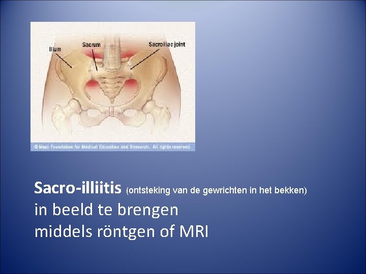 Sacro-illiitis (ontsteking van de gewrichten in het bekken) in beeld te brengen middels röntgen