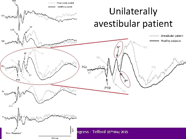Unilaterally avestibular patient BSHAA Congress - Telford 15 th May 2015 