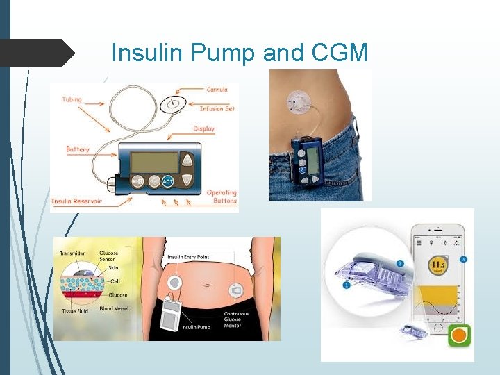 Insulin Pump and CGM 