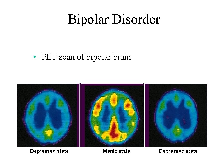 Bipolar Disorder • PET scan of bipolar brain Depressed state Manic state Depressed state