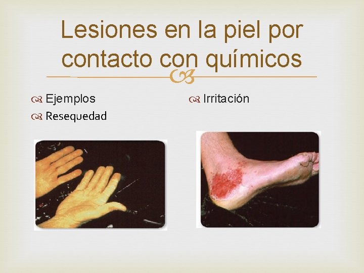 Lesiones en la piel por contacto con químicos Ejemplos Resequedad Irritación 