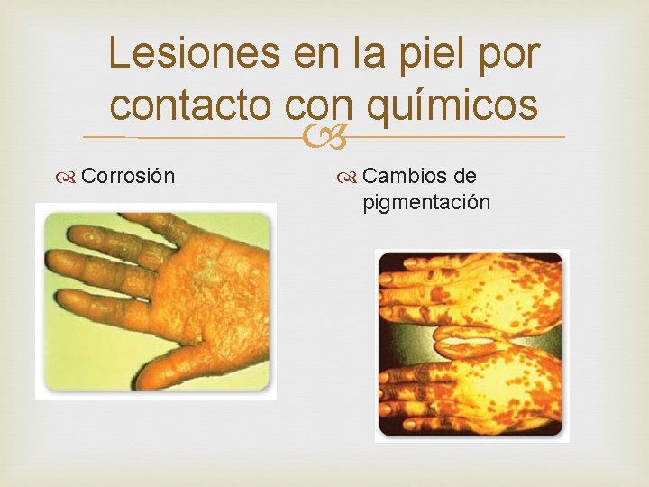 Lesiones en la piel por contacto con químicos Corrosión Cambios de pigmentación 