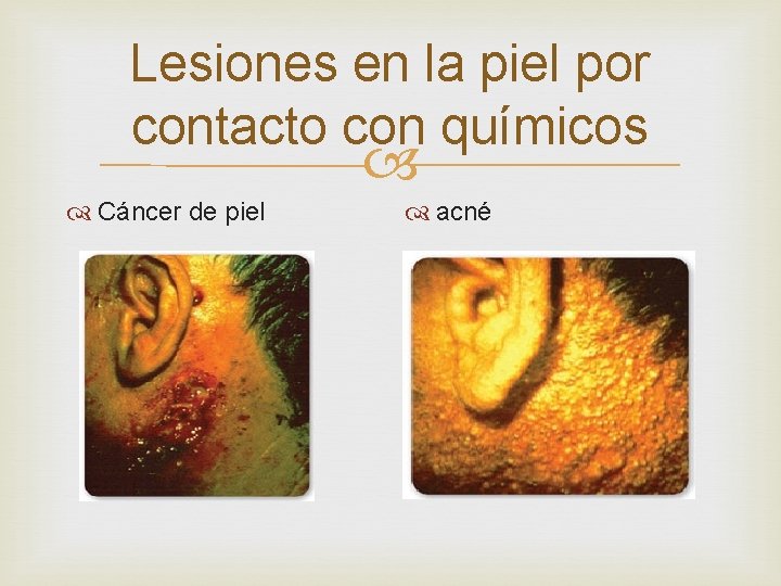 Lesiones en la piel por contacto con químicos Cáncer de piel acné 