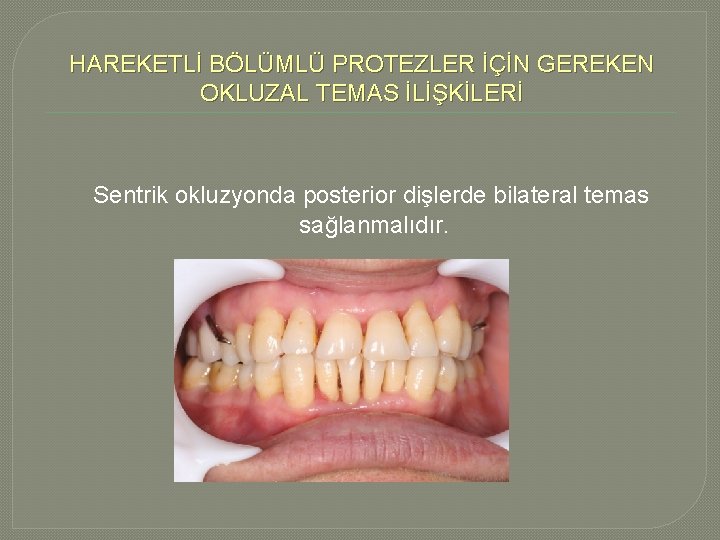 HAREKETLİ BÖLÜMLÜ PROTEZLER İÇİN GEREKEN OKLUZAL TEMAS İLİŞKİLERİ Sentrik okluzyonda posterior dişlerde bilateral temas