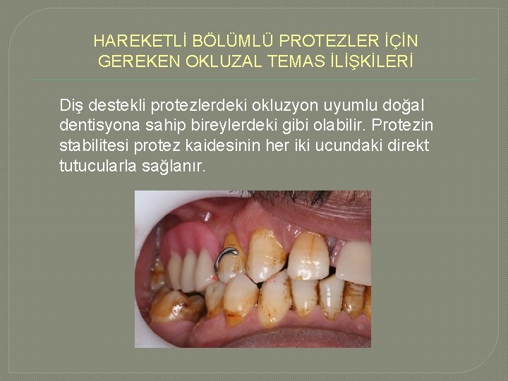 HAREKETLİ BÖLÜMLÜ PROTEZLER İÇİN GEREKEN OKLUZAL TEMAS İLİŞKİLERİ Diş destekli protezlerdeki okluzyon uyumlu doğal