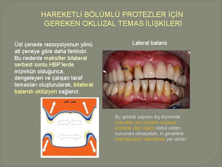 HAREKETLİ BÖLÜMLÜ PROTEZLER İÇİN GEREKEN OKLUZAL TEMAS İLİŞKİLERİ Üst çenede rezorpsiyonun yönü alt çeneye