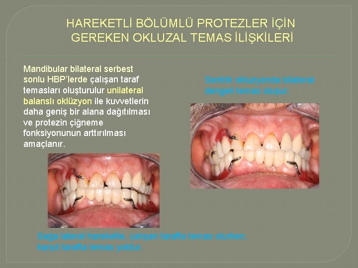 HAREKETLİ BÖLÜMLÜ PROTEZLER İÇİN GEREKEN OKLUZAL TEMAS İLİŞKİLERİ Mandibular bilateral serbest sonlu HBP’lerde çalışan