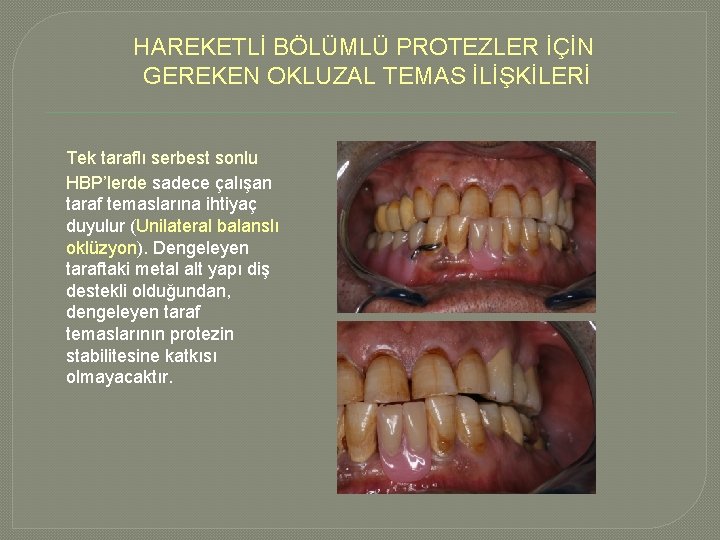 HAREKETLİ BÖLÜMLÜ PROTEZLER İÇİN GEREKEN OKLUZAL TEMAS İLİŞKİLERİ Tek taraflı serbest sonlu HBP’lerde sadece