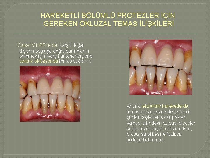 HAREKETLİ BÖLÜMLÜ PROTEZLER İÇİN GEREKEN OKLUZAL TEMAS İLİŞKİLERİ Class IV HBP’lerde, karşıt doğal dişlerin