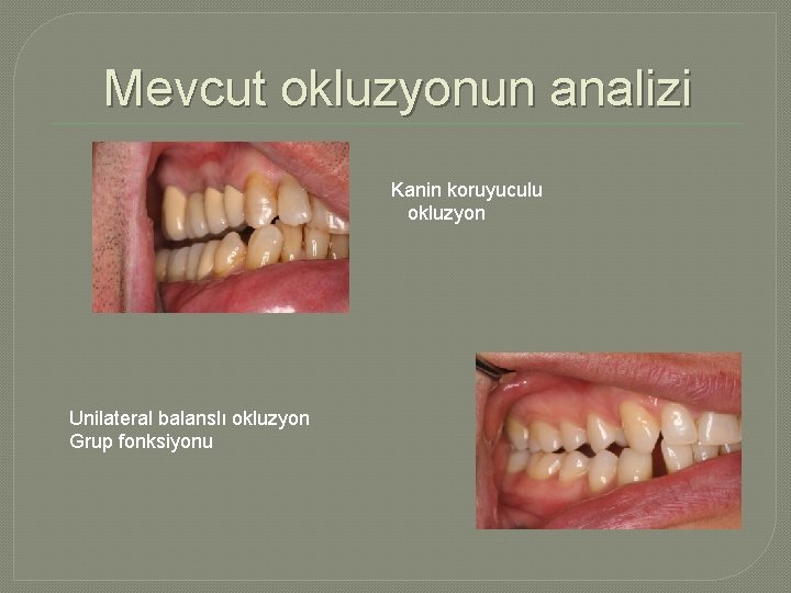 Mevcut okluzyonun analizi Kanin koruyuculu okluzyon Unilateral balanslı okluzyon Grup fonksiyonu 