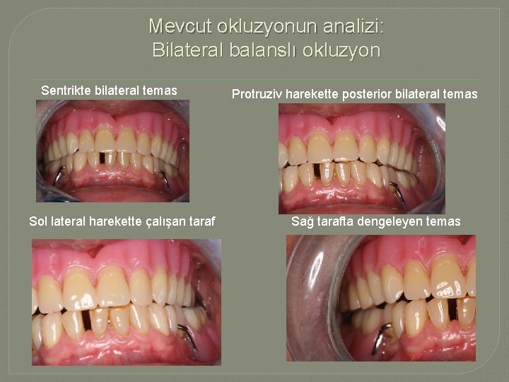 Mevcut okluzyonun analizi: Bilateral balanslı okluzyon Sentrikte bilateral temas Sol lateral harekette çalışan taraf