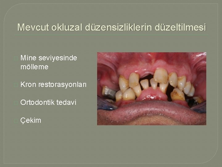 Mevcut okluzal düzensizliklerin düzeltilmesi � Mine seviyesinde mölleme � Kron restorasyonları � Ortodontik tedavi