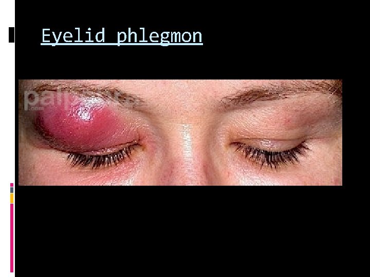 Eyelid phlegmon 