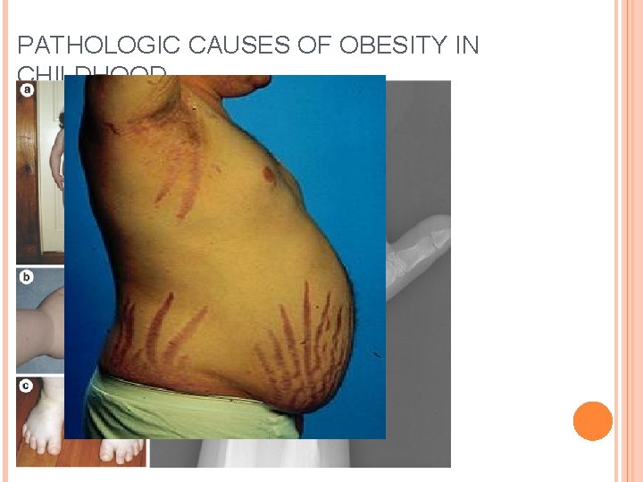 PATHOLOGIC CAUSES OF OBESITY IN CHILDHOOD Pseudohypoparathyroidism Albright Hereditary Osteodystrophy Cushing syndrome Laurence Moon
