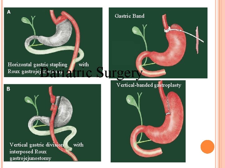 Gastric Band Horizontal gastric stapling with Roux gastrojejunostomy Bariatric Surgery Vertical-banded gastroplasty Vertical gastric