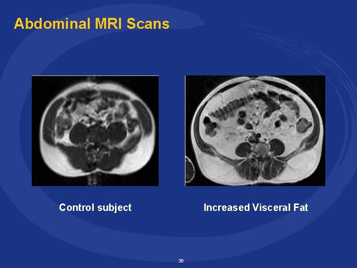 Abdominal MRI Scans Control subject Increased Visceral Fat 36 