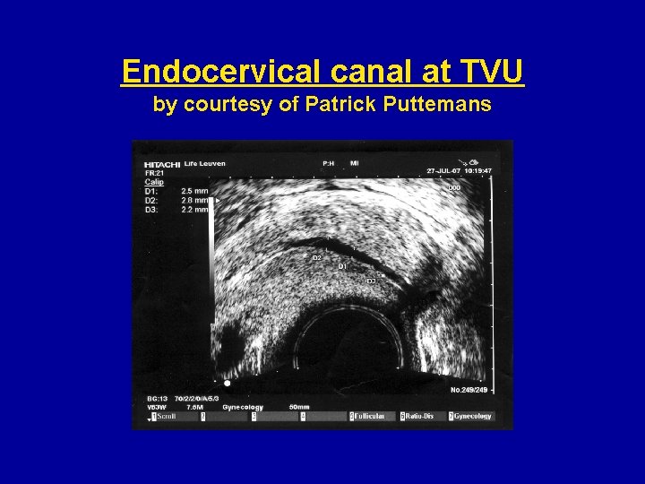 Endocervical canal at TVU by courtesy of Patrick Puttemans 