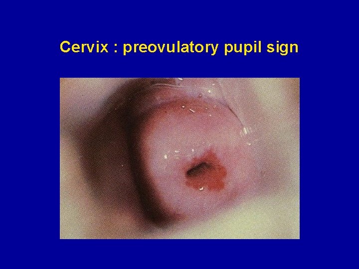 Cervix : preovulatory pupil sign 