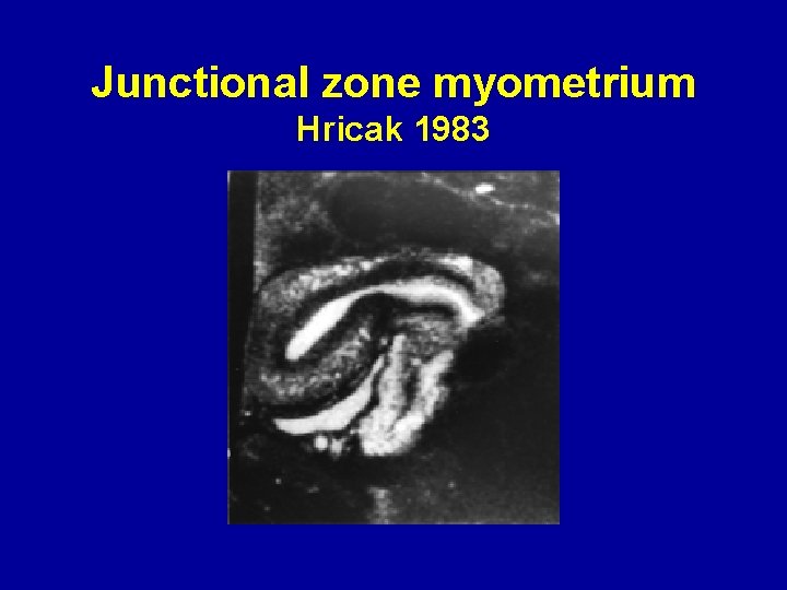 Junctional zone myometrium Hricak 1983 