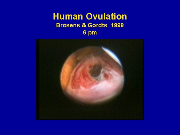 Human Ovulation Brosens & Gordts 1998 6 pm 