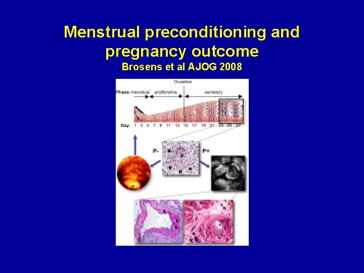 Menstrual preconditioning and pregnancy outcome Brosens et al AJOG 2008 