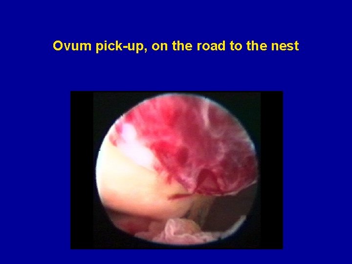 Ovum pick-up, on the road to the nest 