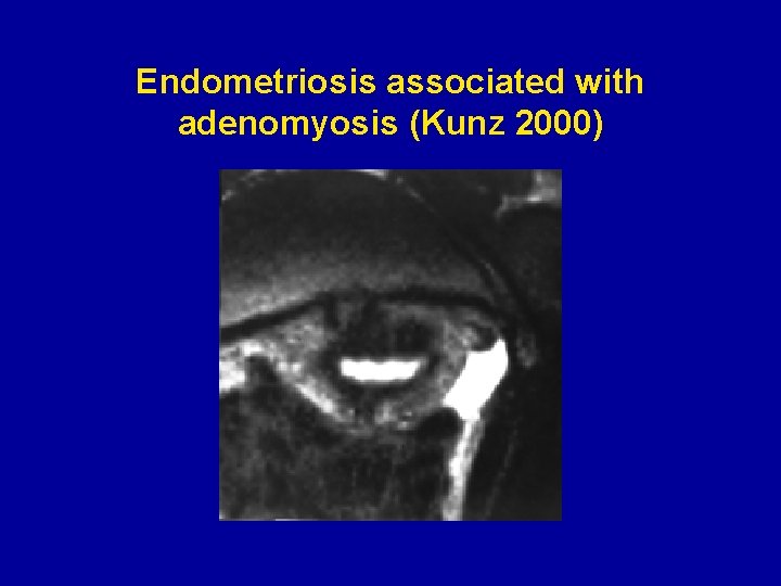 Endometriosis associated with adenomyosis (Kunz 2000) 