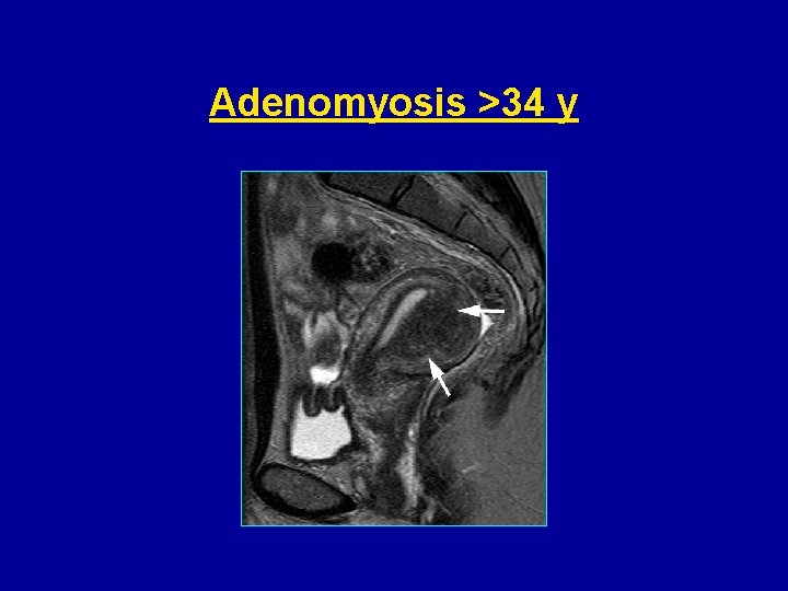 Adenomyosis >34 y 