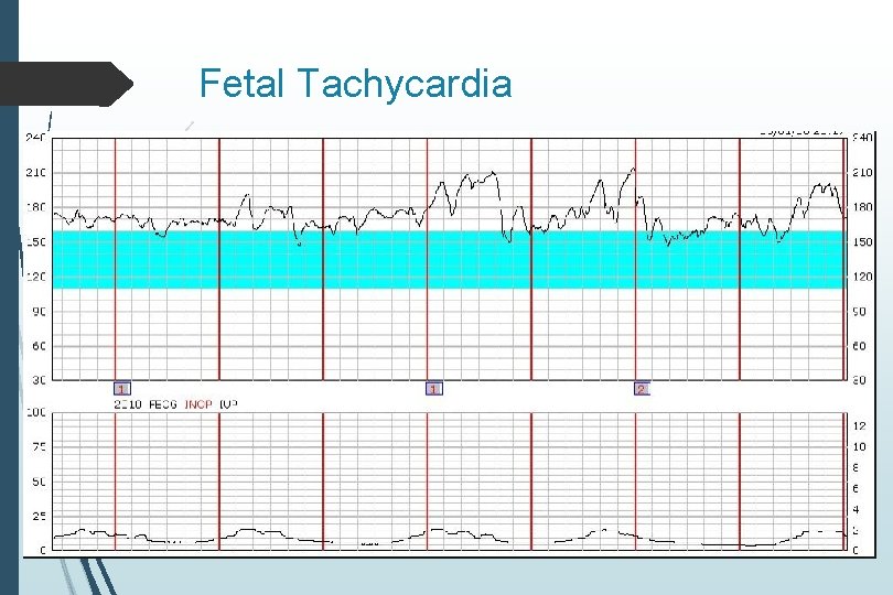 Fetal Tachycardia Fetal Tachycardia