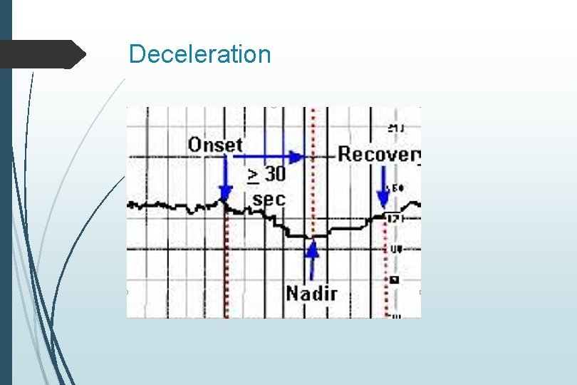 Deceleration Deceleration